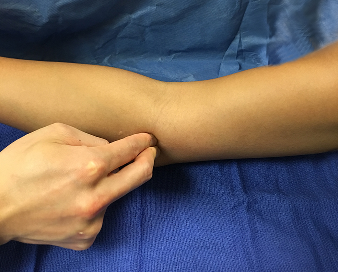 Medial Epicondylitis Tenderness with Resisted Wrist Flexion Hand